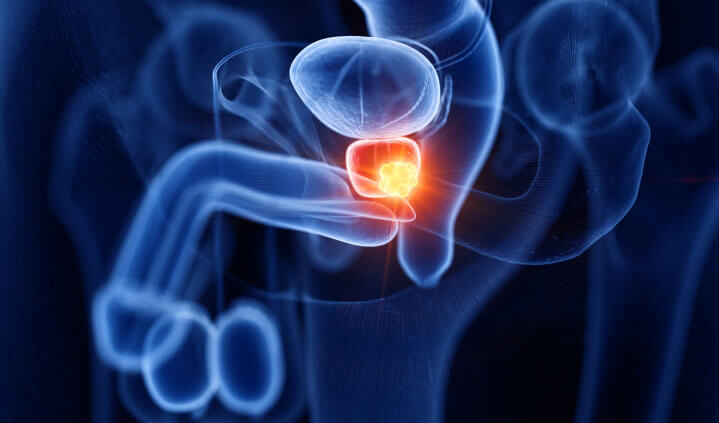 Prostatitis Singapore